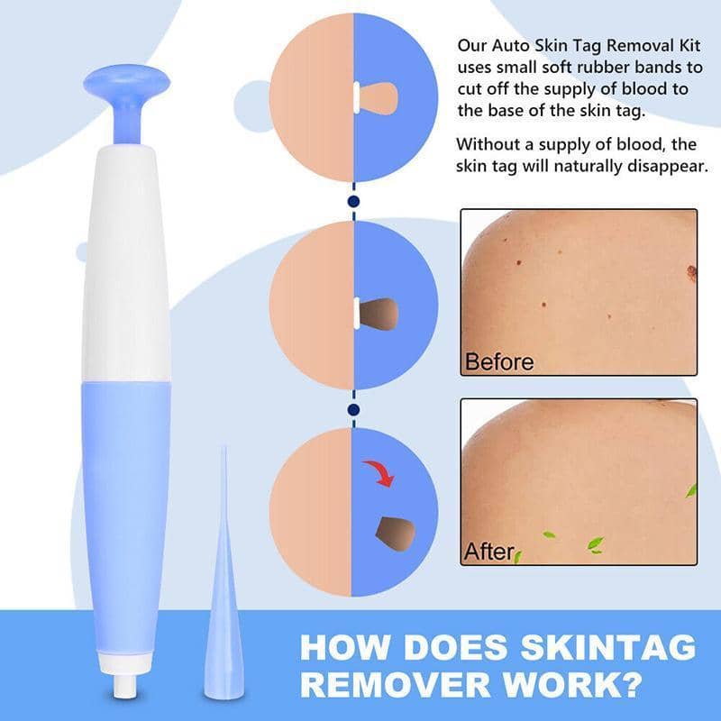 Auto Skin Tag Remover Kit with Bands and Band Loader - view 3
